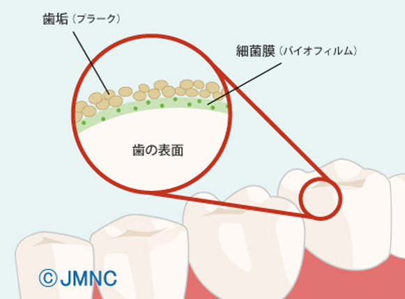 虫歯とは