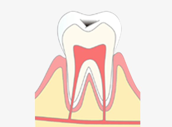 C1 エナメル質までの虫歯