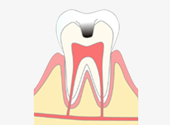 C2 象牙質に達する虫歯