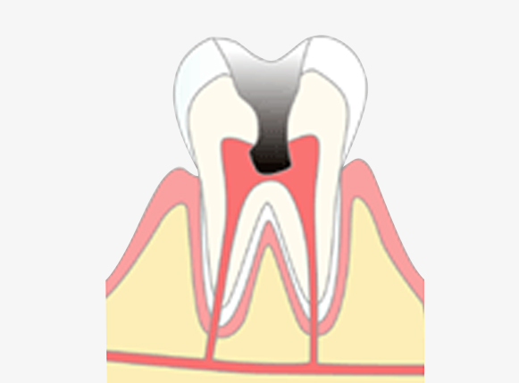 C3 神経に達する虫歯