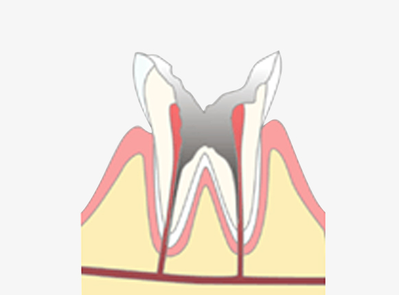 C4 歯の根に達する虫歯
