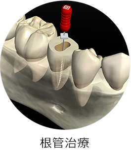 根管治療