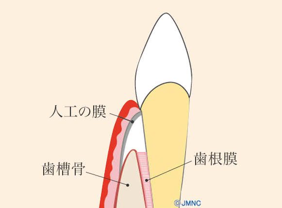 歯周組織再生療法（GTR法）