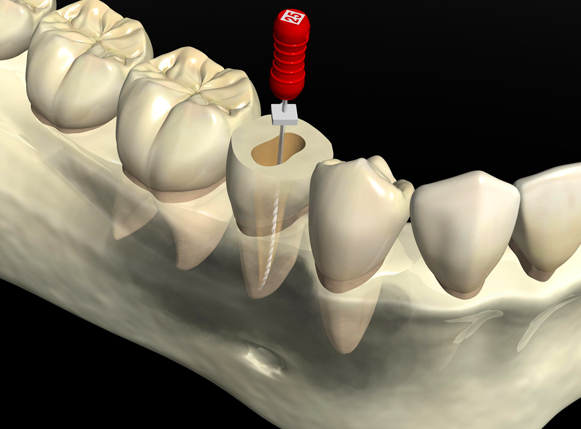 根管治療